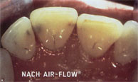 berlin Zahnarzt AIR-FLOW