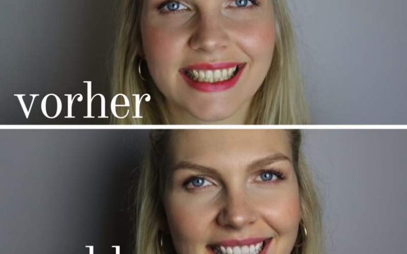 Bloggerin Jessy liebt ihre neuen weißen Zähne!